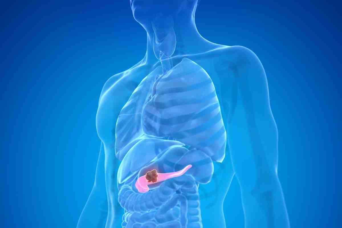tumore al pancreas