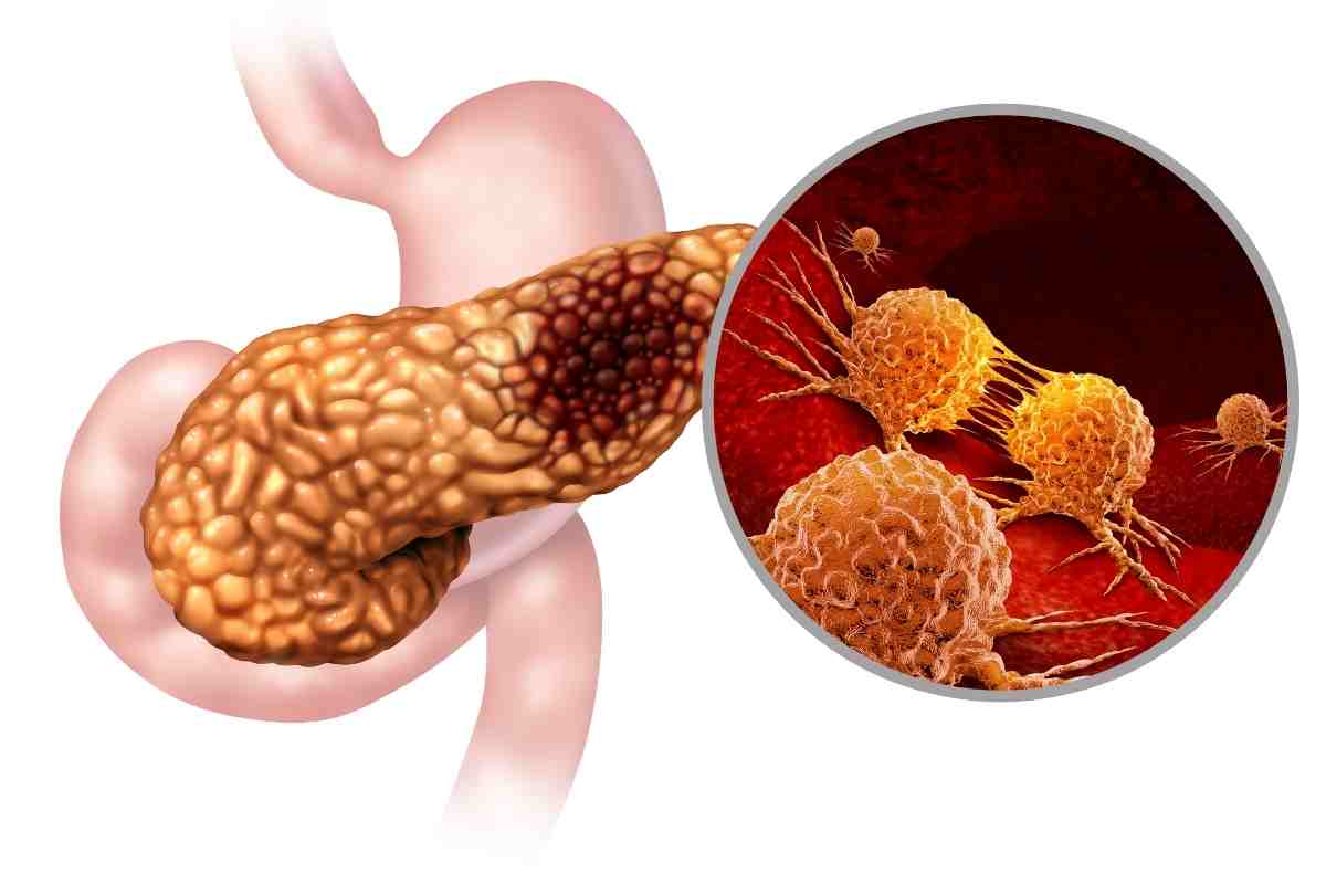 tumore al pancreas